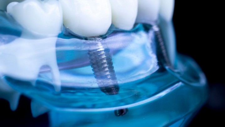 Implantologia Clínica Rio Este